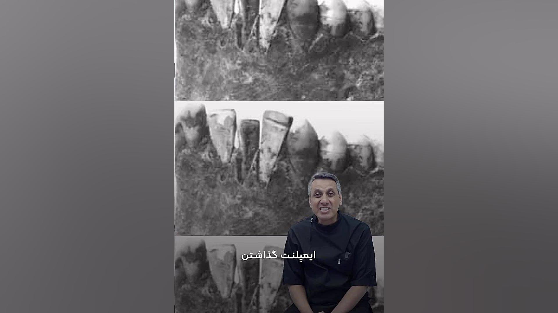 ایمپلنت دیجیتال چقدر زمان می برد دکتر سید محمدرضا حسینی