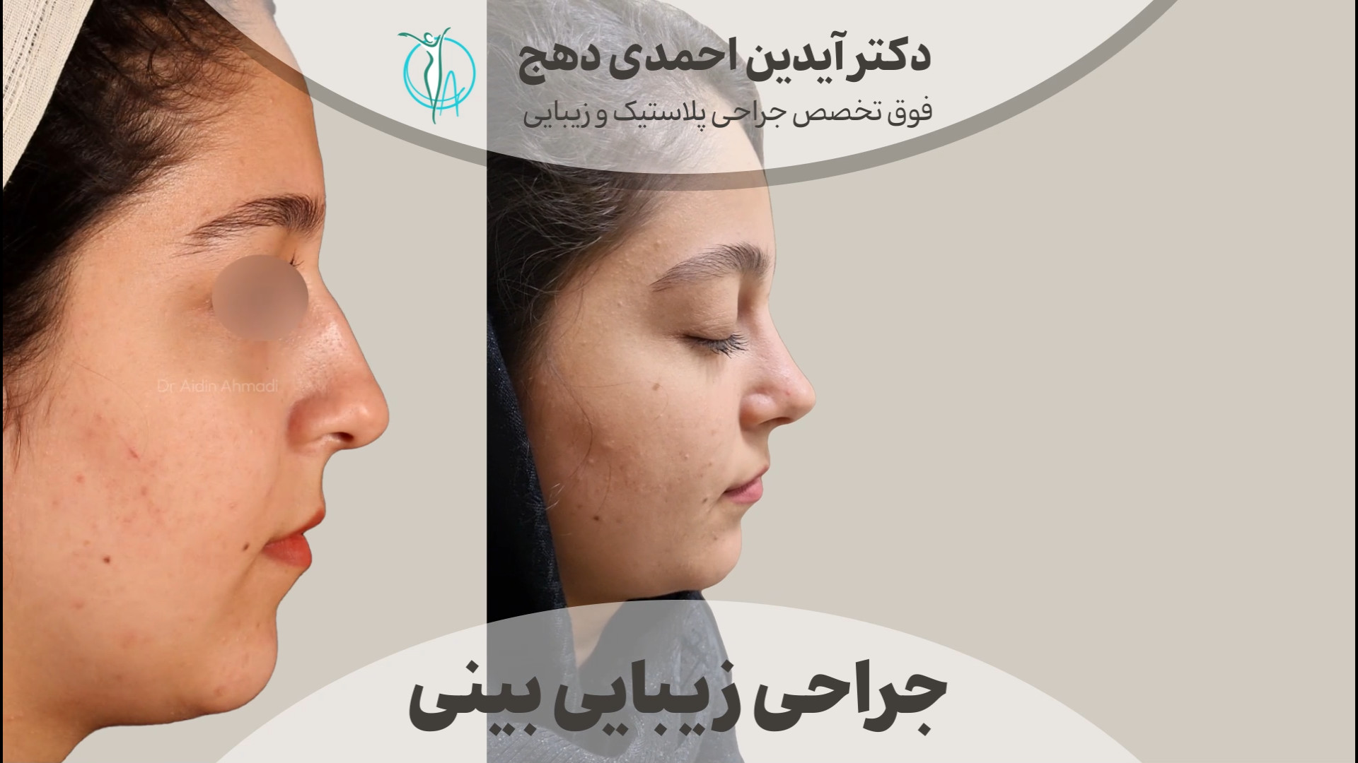 نتیجه فوق العاده جراحی بینی طبیعی دکتر آیدین احمدی دهج | جراح پلاستیک