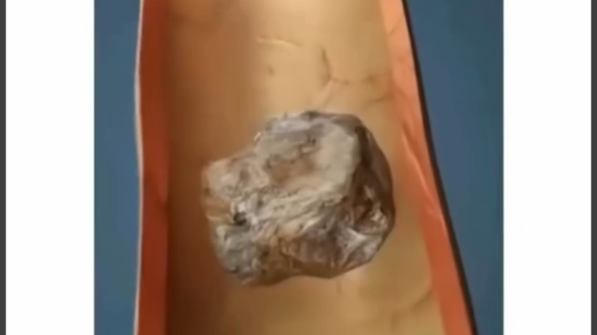 نحوه دفع سنگ کلیه بلیچینگ