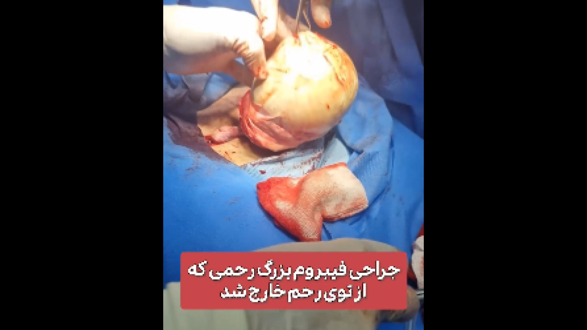 جراحی فیبروم رحمی دکتر زهرا طالب زاده