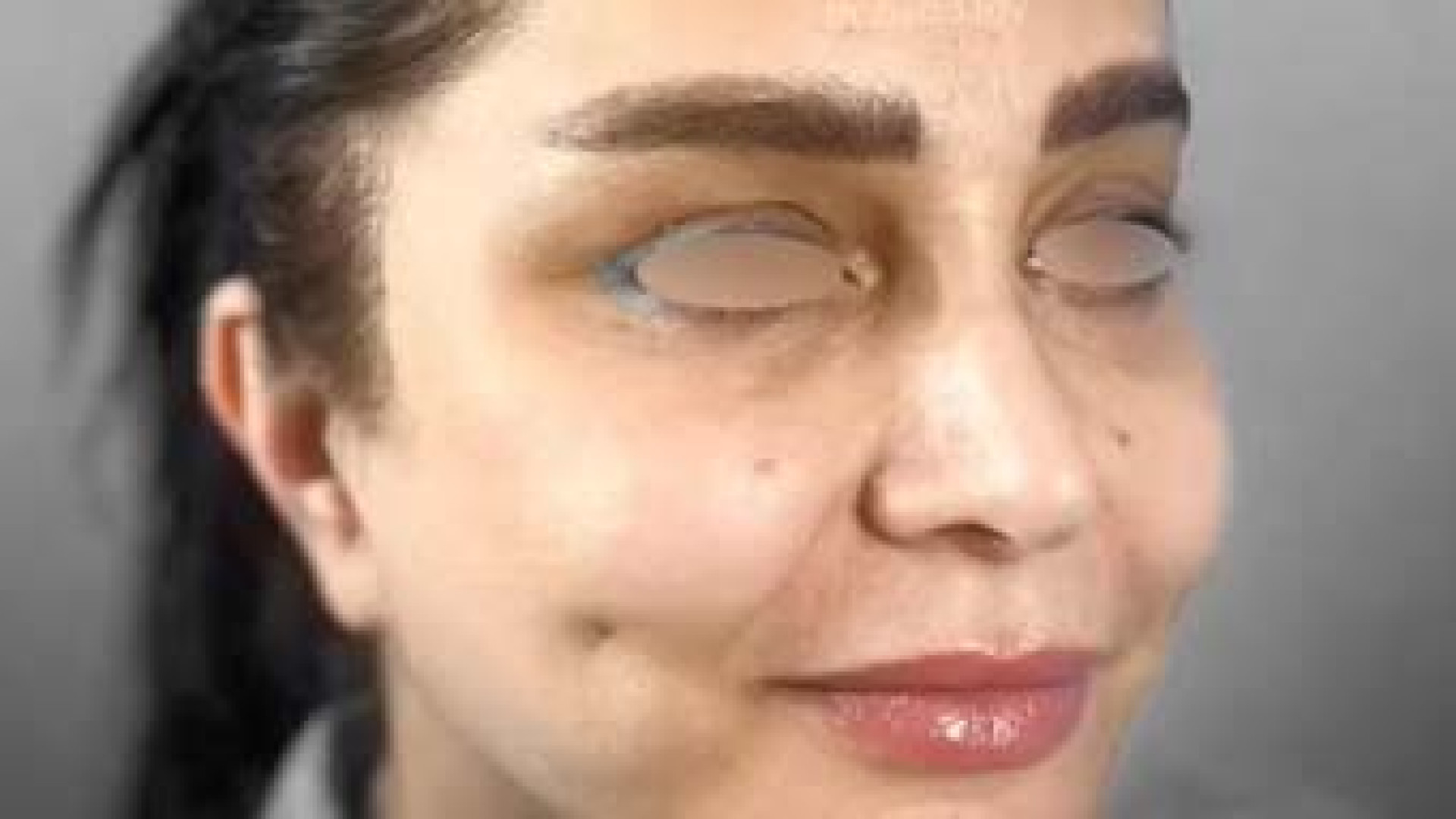 جراحی لیفت آندوسکوپی ابرو و لیفت صورت | دکتر حدادی جراحی بینی
