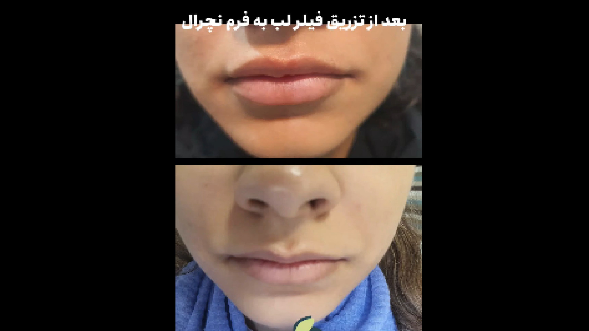 تزریق فیلر لب نچرال دکتر ایمان روغنی جراح و متخصص پوست و مو