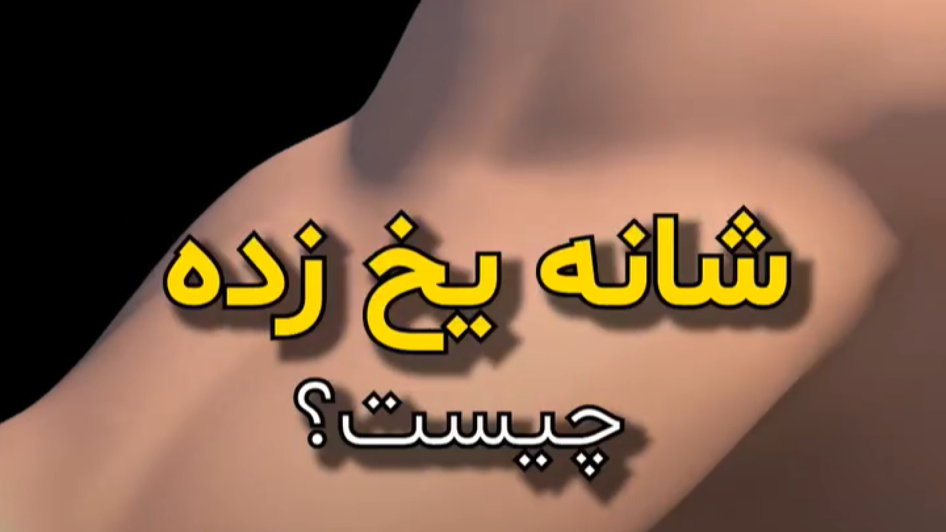 شانه یخ زده چیست؟ دکتر آرش اریس