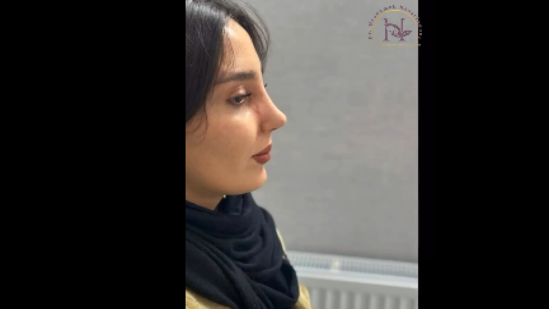 ورم بعد از جراحی بینی دکتر معصومه حسین پور