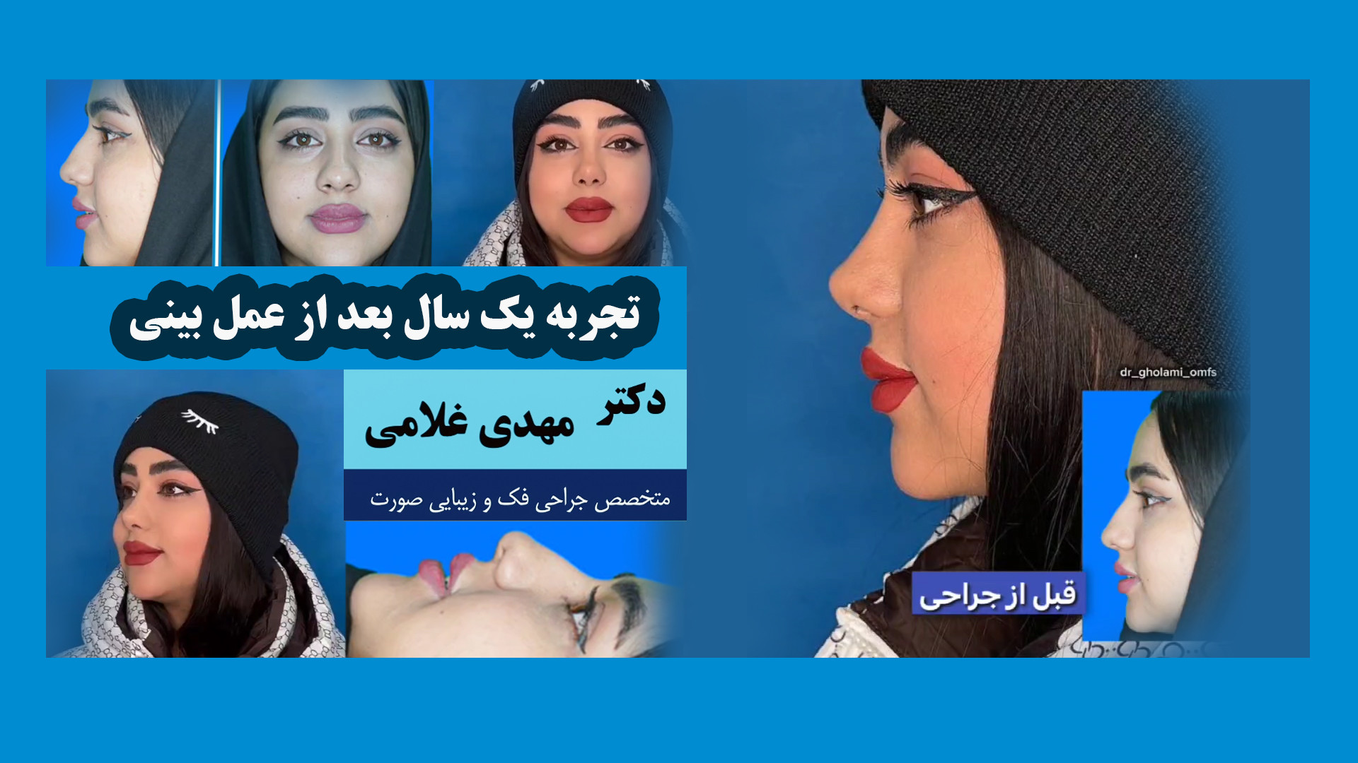 تجربه یکسال بعد از عمل بینی دکتر مهدی غلامی