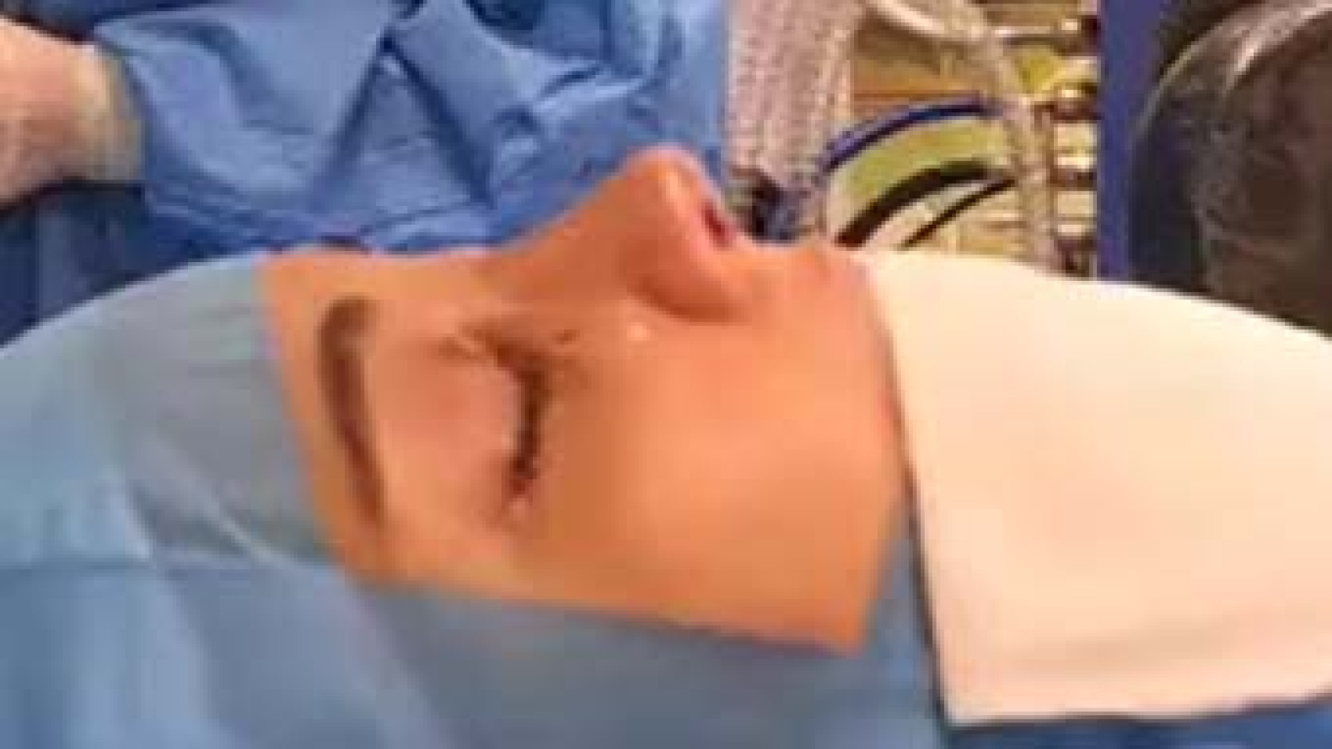 بلافاصله بعد از جراحی بینی | دکتر محبی