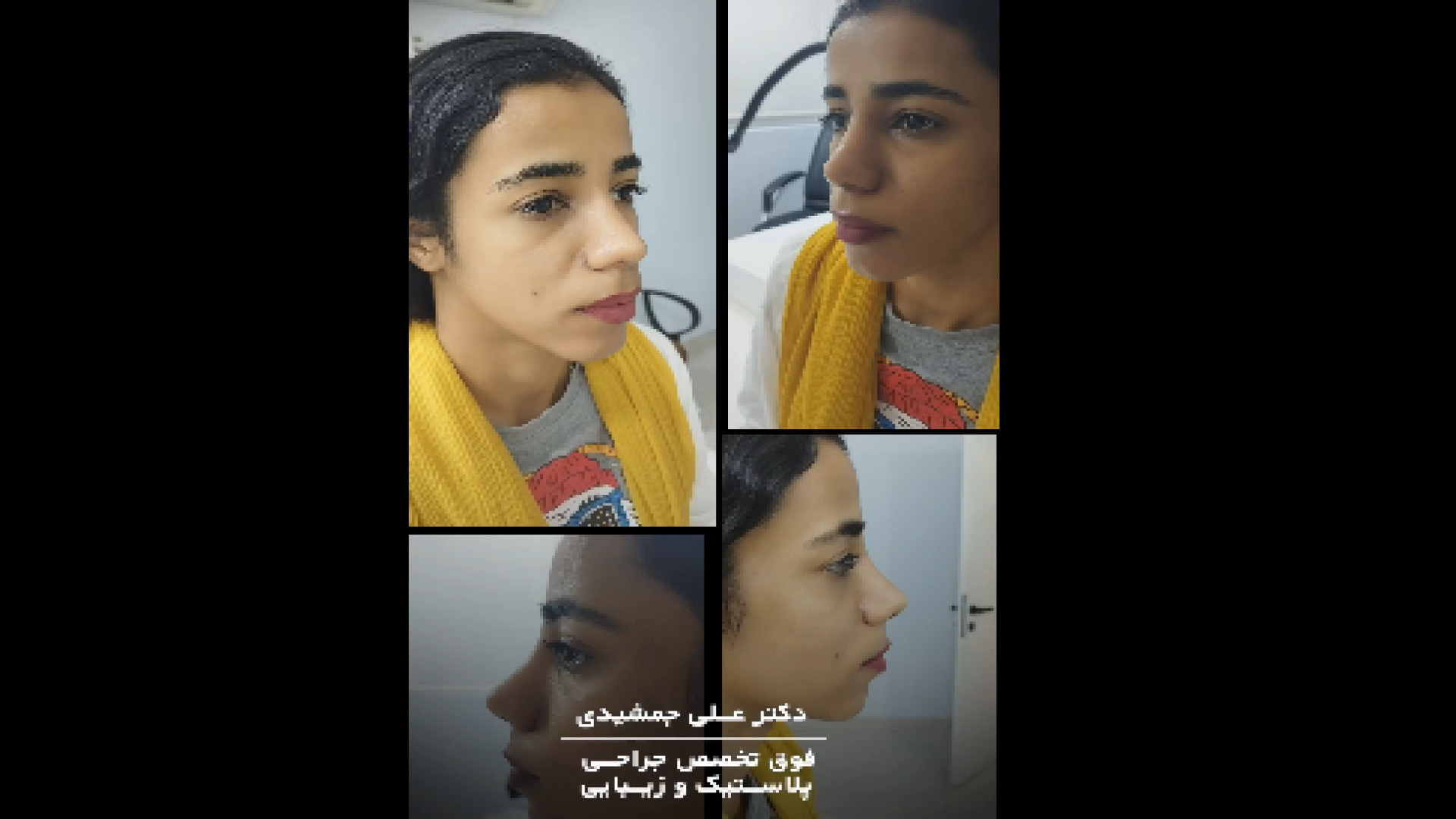 یک ماه بعد از عمل بینی دکتر علی جمشیدی