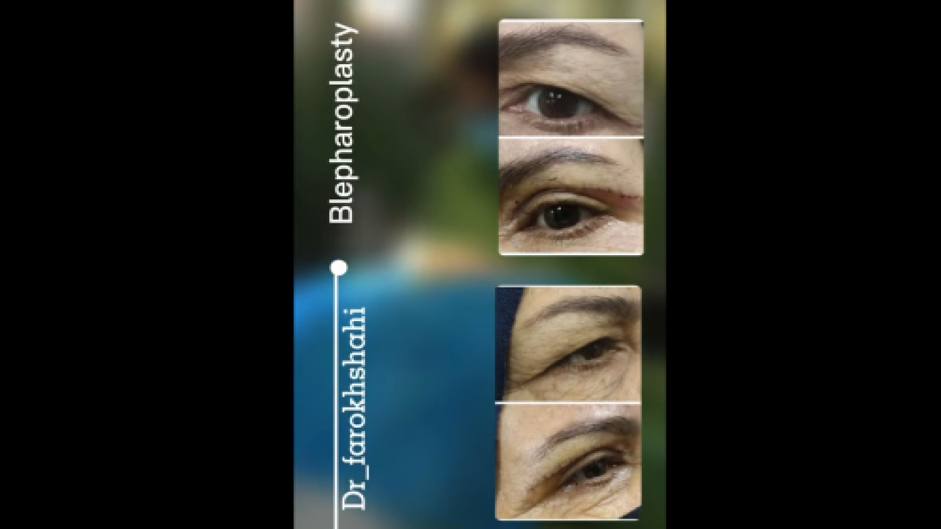 نمونه کار بلفاروپلاستی دکتر مریم فرخشاهی - پوست، مو و زیبایی