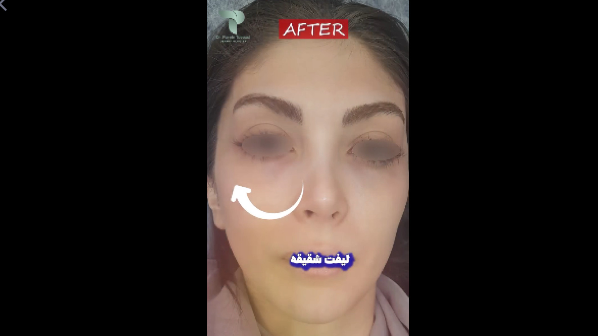 تزریق فیلر شقیقه دکتر پروین طاوسی - متخصص پوست، مو و زیبایی
