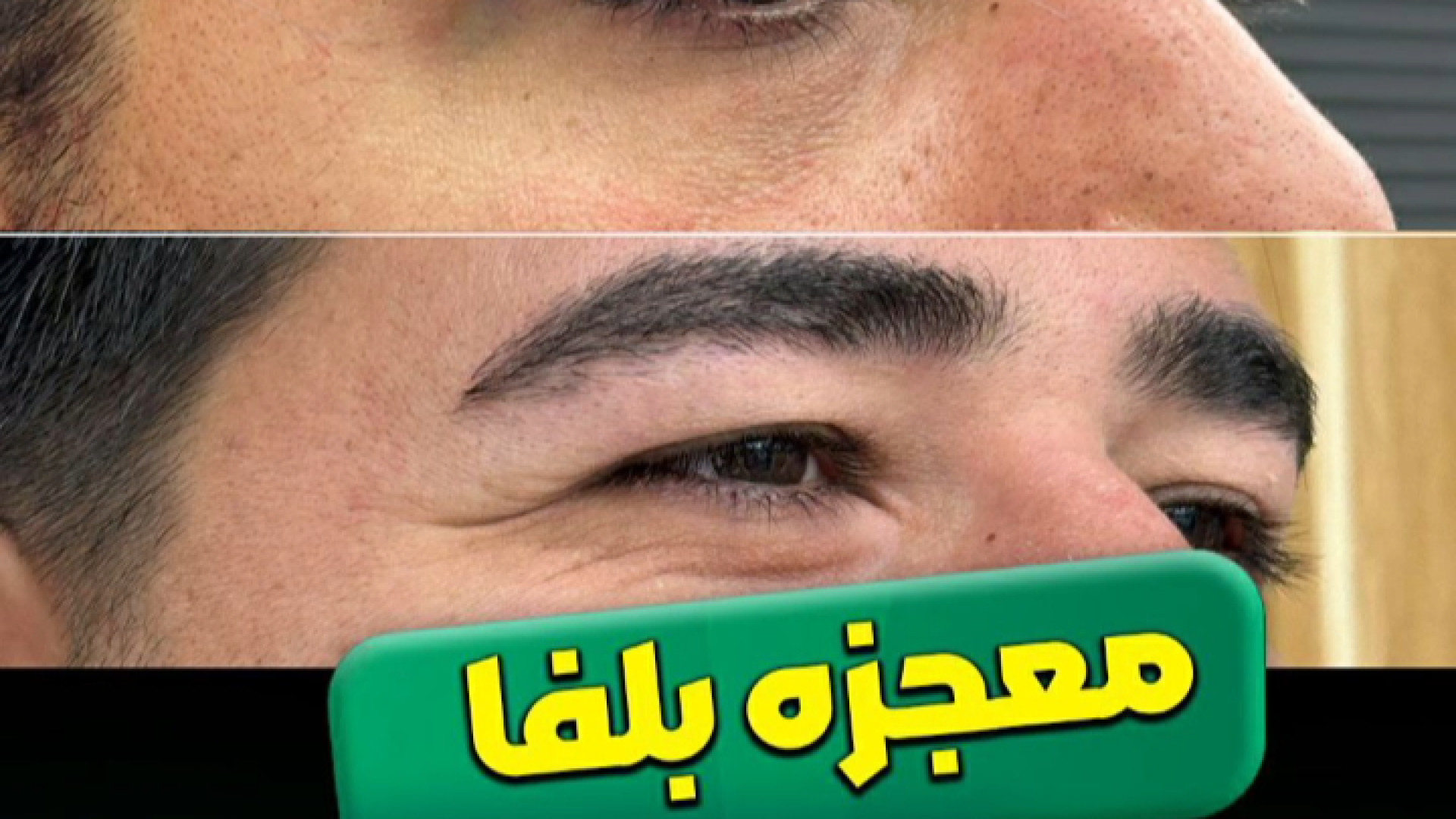 بلفاروپلاستی مردان همراه با فیکس ابرو پر کردن دندان