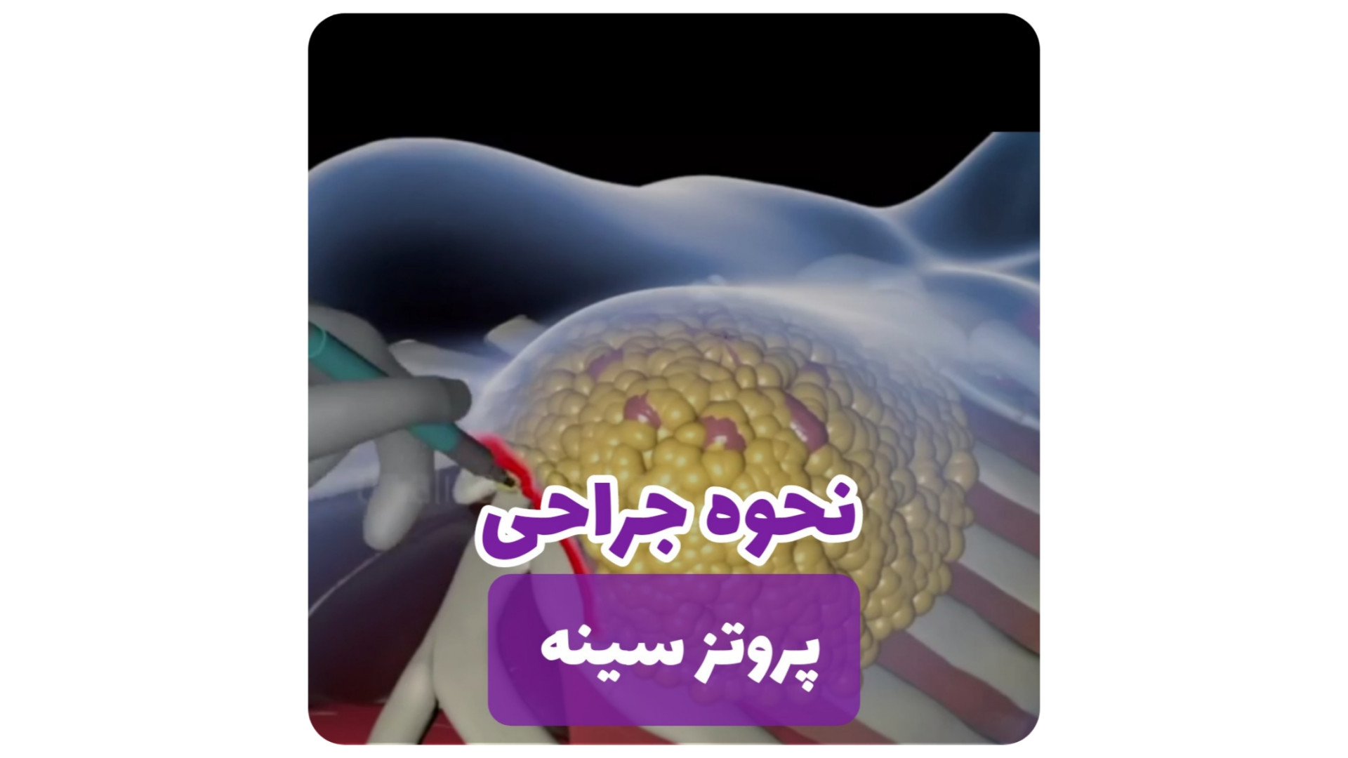 پروتز سینه اقساطی در مشهد بیورآکتور سه‌بعدی