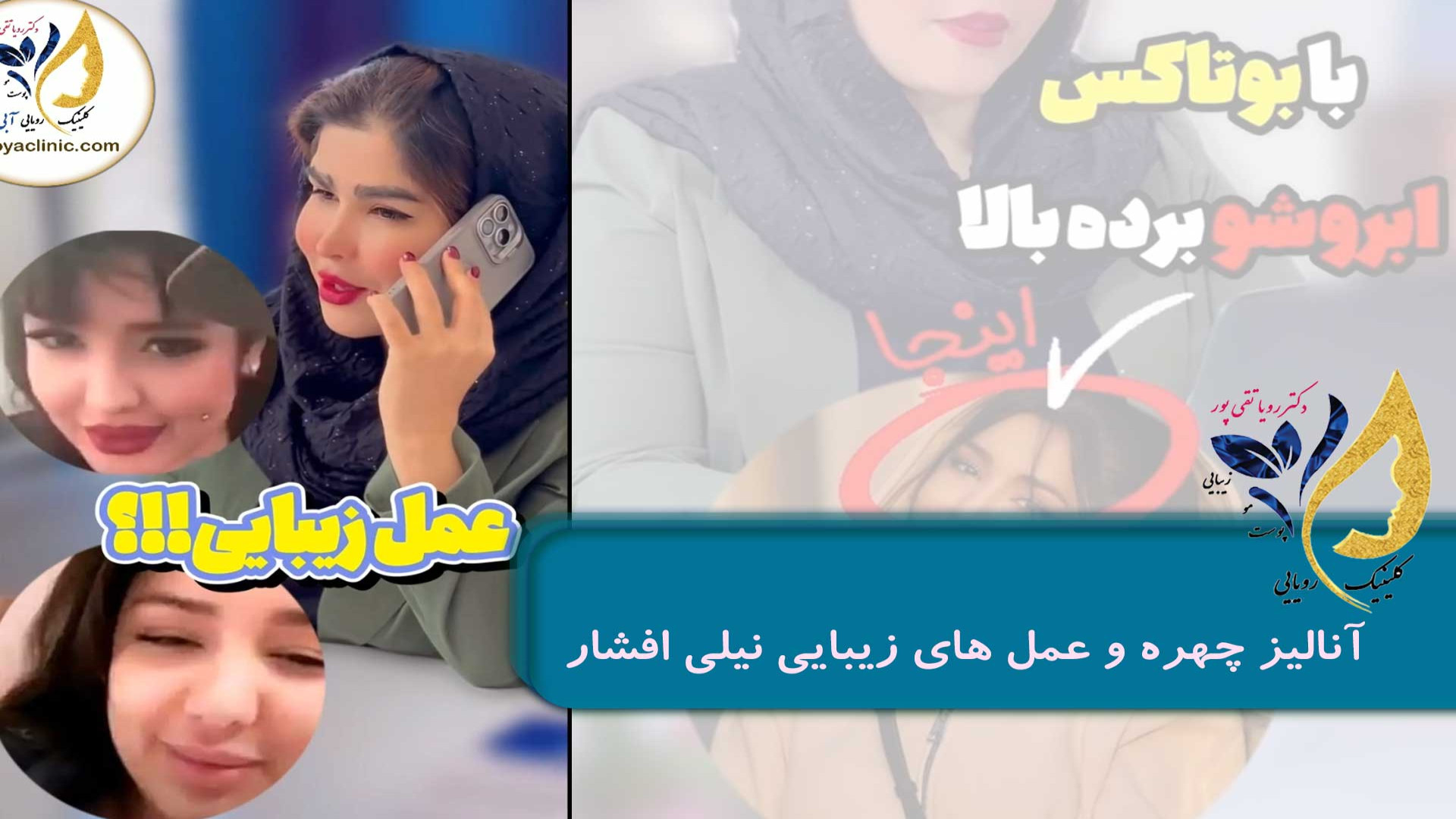 آنالیز چهره و عمل های زیبایی نیلی افشار بیلی آیلیش