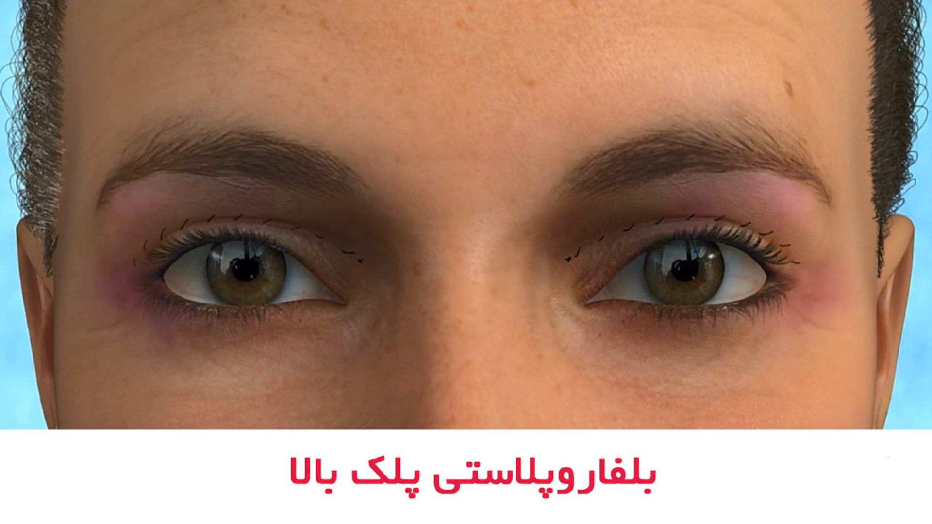 بلفاروپلاستی یا جراحی پلک بالا چگونه انجام میشود؟ دكتر امان اله قاسم زاده