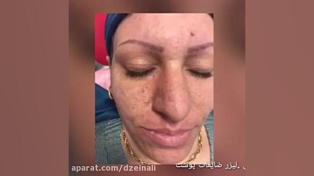 لیزر co2 رفع خال و ضایعات پوست دکتر فرحناز زینعلی - متخصص پوست، مو، زیبایی زنجان