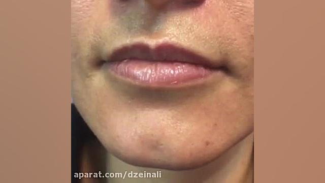 تزریق ژل دکتر فرحناز زینعلی - متخصص پوست، مو، زیبایی زنجان