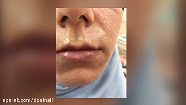 تزریق ژل دکتر فرحناز زینعلی - متخصص پوست، مو، زیبایی زنجان