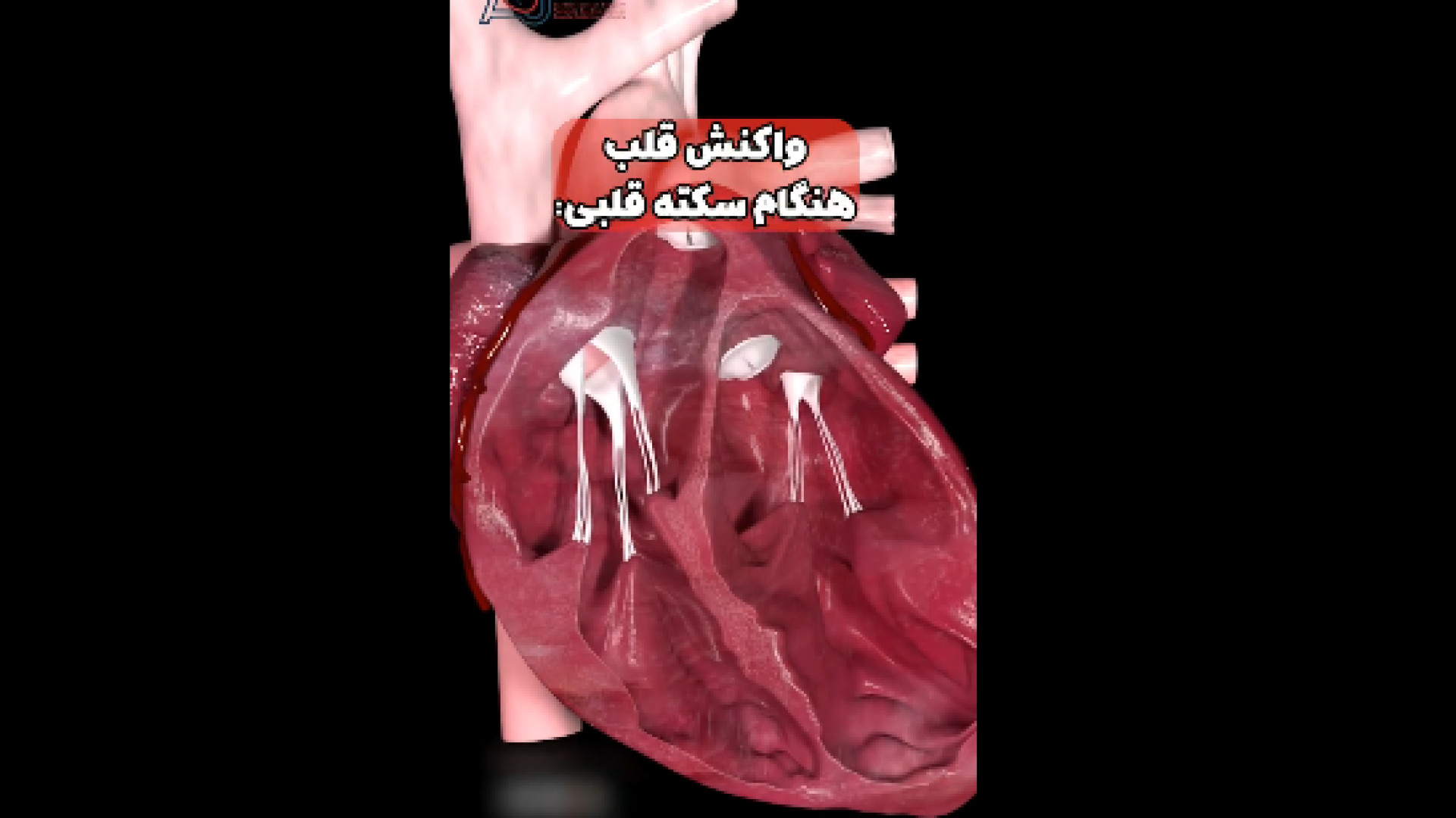 واکنش قلب حین سکته قلبی لیزر مو