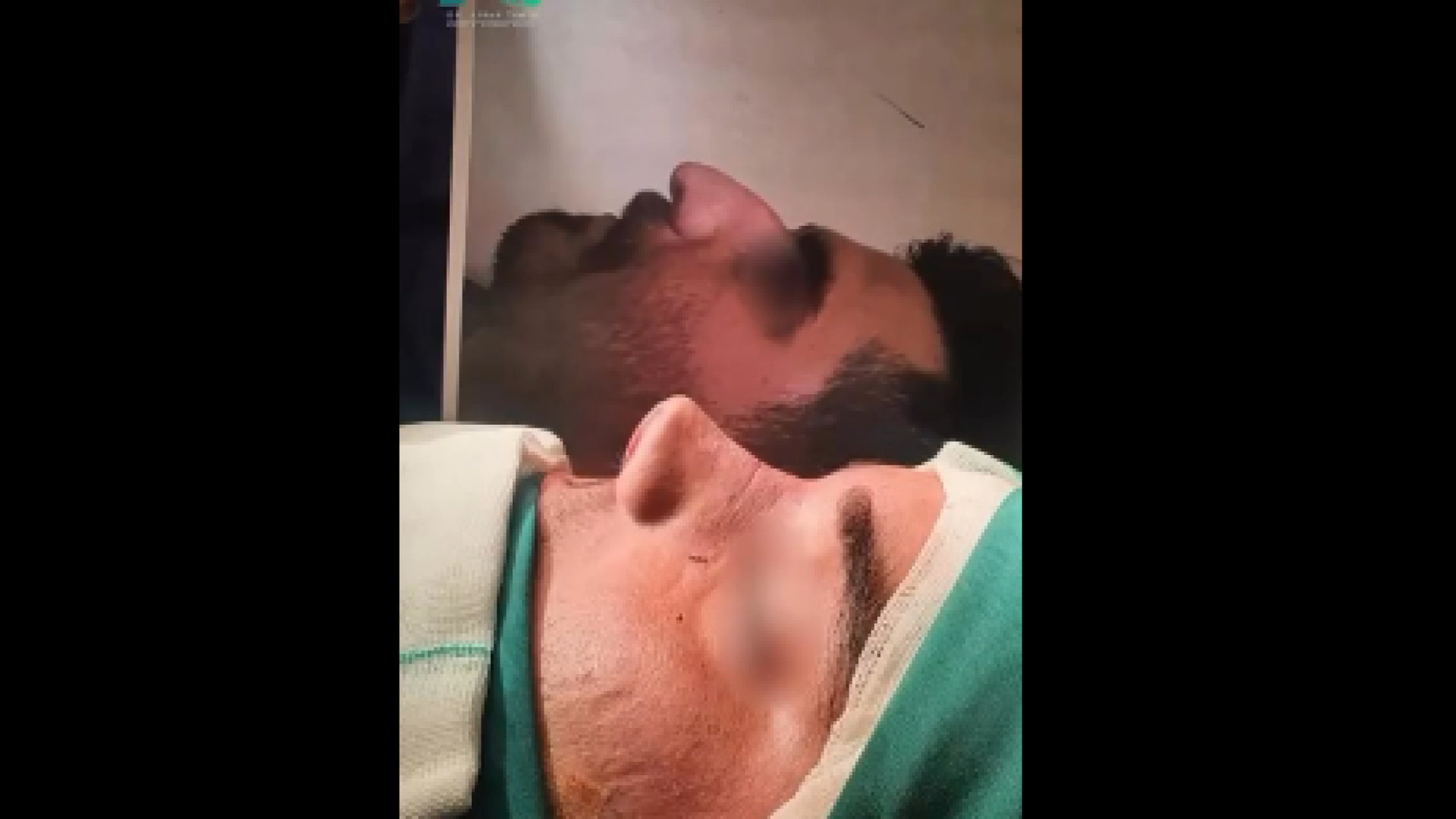 بلافاصله بعد از عمل بینی دکتر محمودرضا اصحاب یمین - فوق تخصص پلاستیک