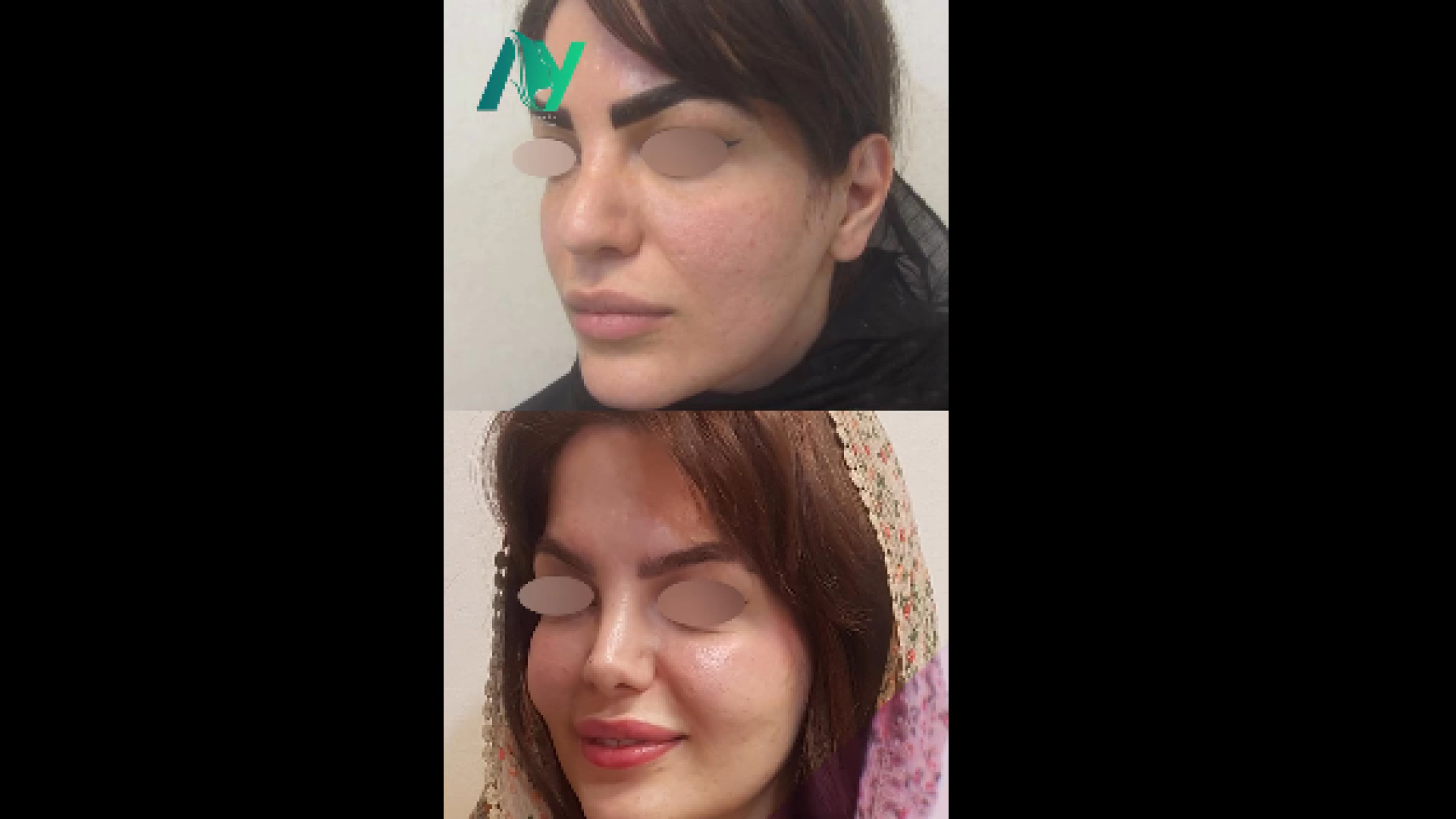 نتیجه رینوپلاستی توسط دکتر اصحاب یمین دکتر محمودرضا اصحاب یمین - فوق تخصص پلاستیک