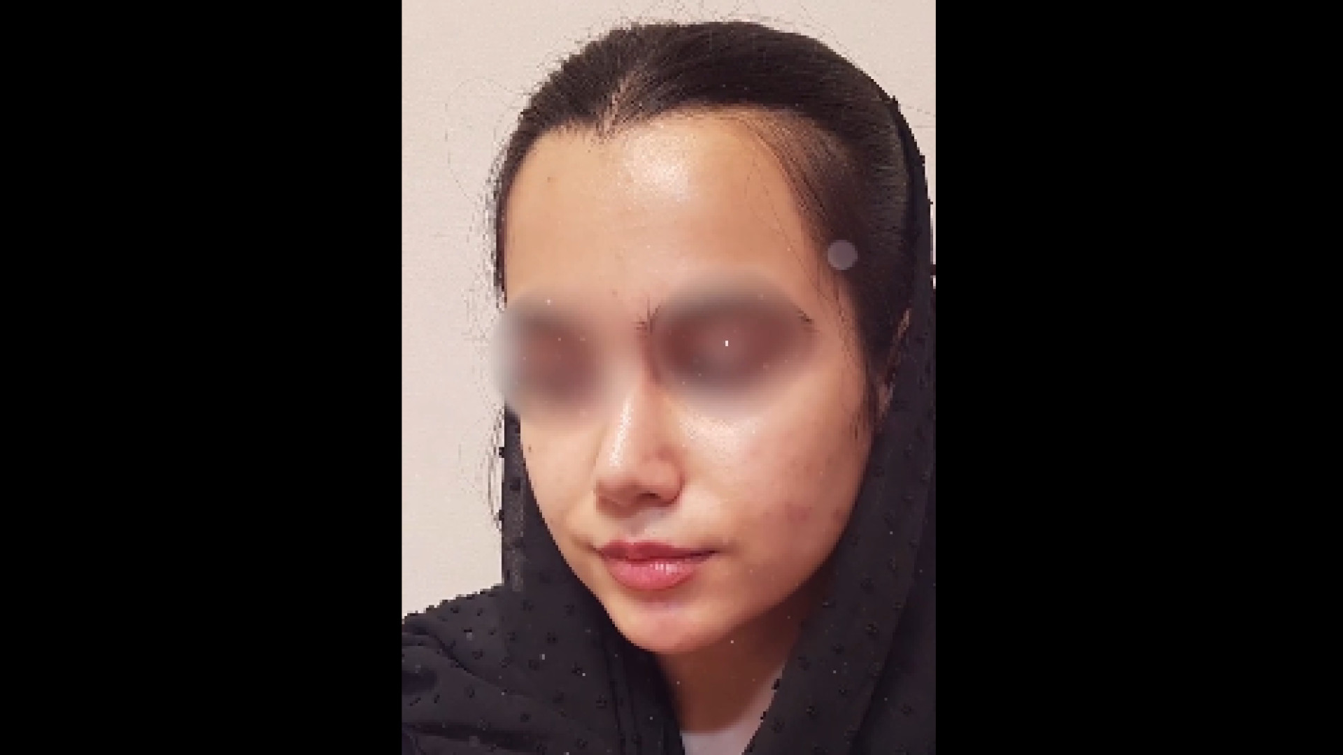 نمونه کار دکتر محمودرضا اصحاب یمین هولوگرام سه‌بعدی جراحی