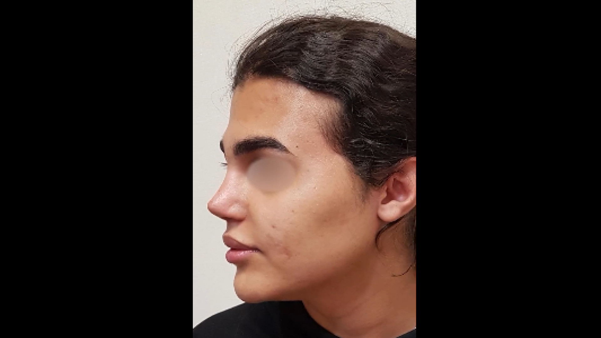 نتیجه جراحی بینی ثانویه دکتر محمودرضا اصحاب یمین - فوق تخصص پلاستیک