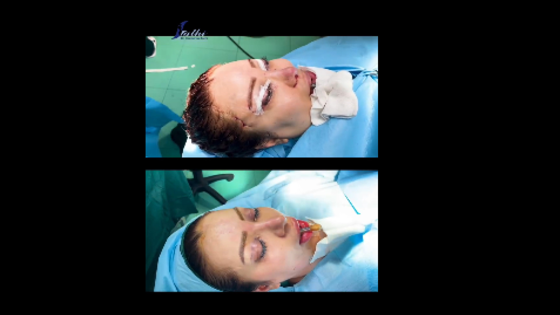 عمل همزمان لیفت پیشانی و شقیقه، بلفاروپلاستی و رینوپلاستی دکتر حمید رضا فتحی فوق تخصص جراحی پلاستیک