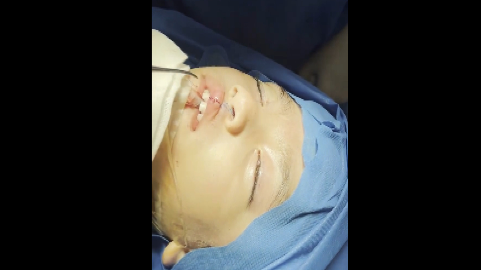 جراحی ترمیم شکاف لب دکتر حمید رضا فتحی فوق تخصص جراحی پلاستیک