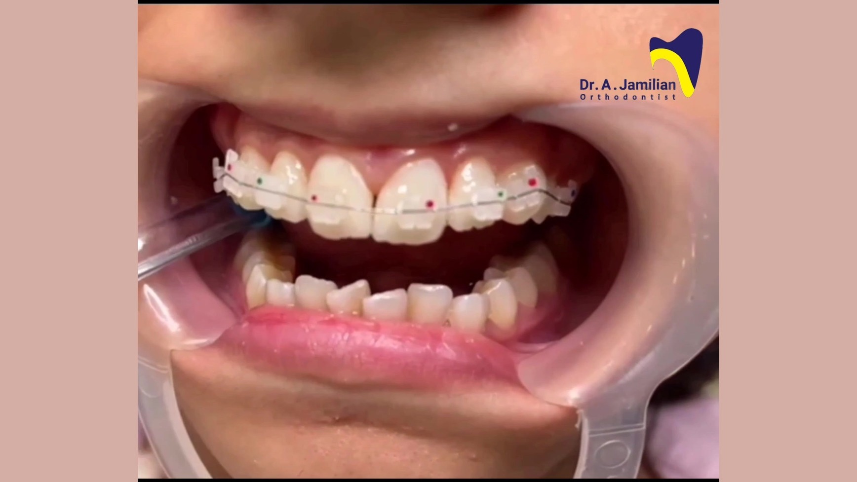 نصب ارتودنسی سرامیکی / متخصص ارتودنسی / پروفسور جمیلیان دکتر عبدالرضا جمیلیان - متخصص ارتودنسی