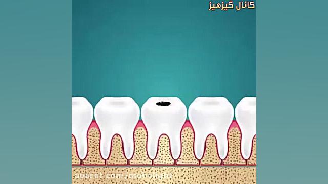فیم ترمیم و عصب کشی دندان Screening Lentiviral Vector