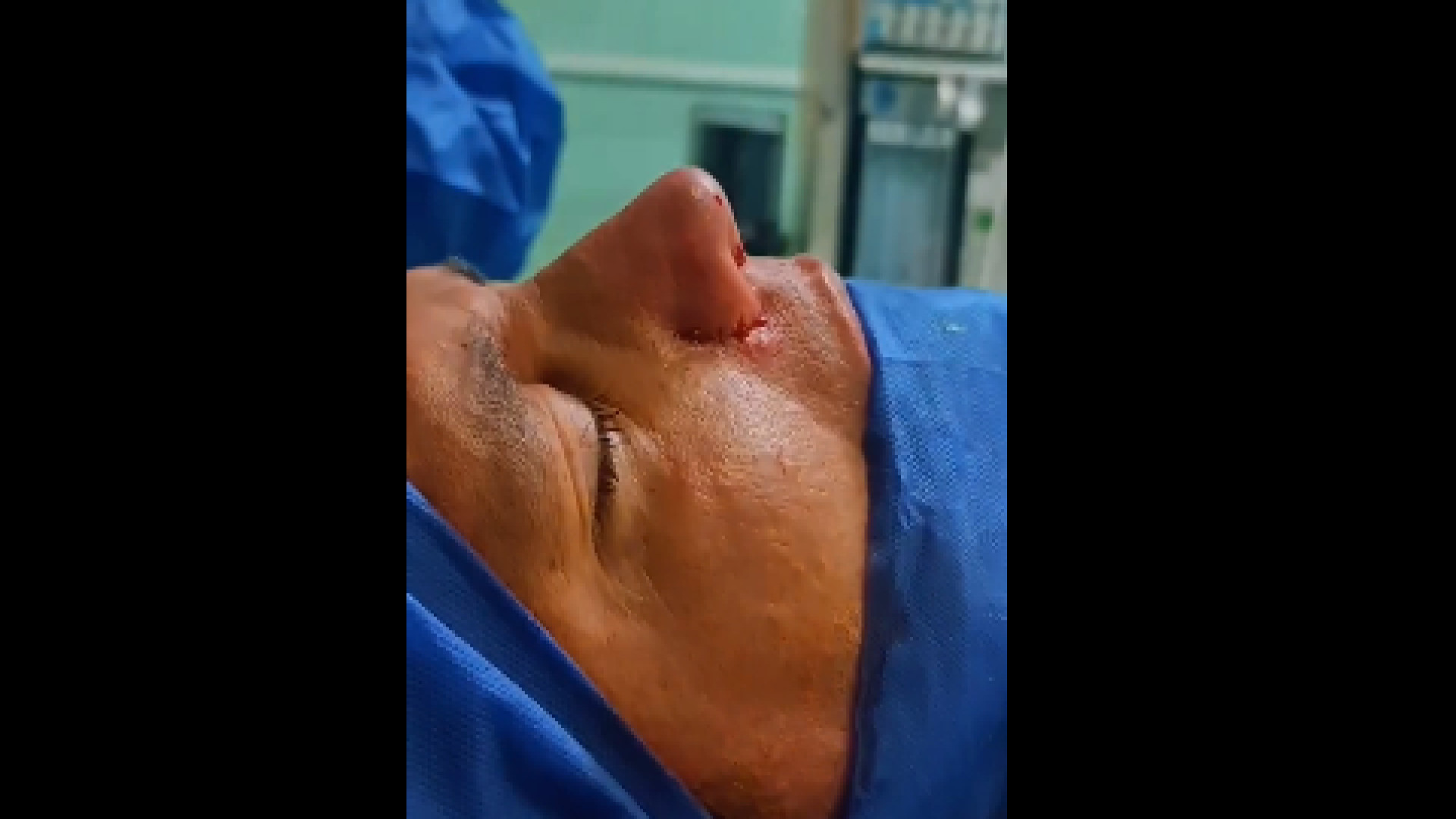 عمل بینی مردانه دکتر شاهین بهجو - فوق تخصص جراحی پلاستیک