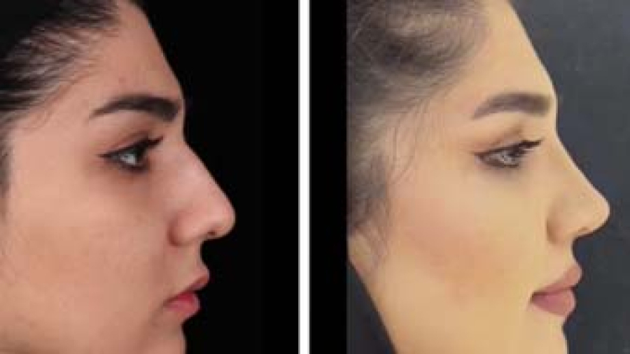 جراحی زیبایی بینی | دکتر نظری