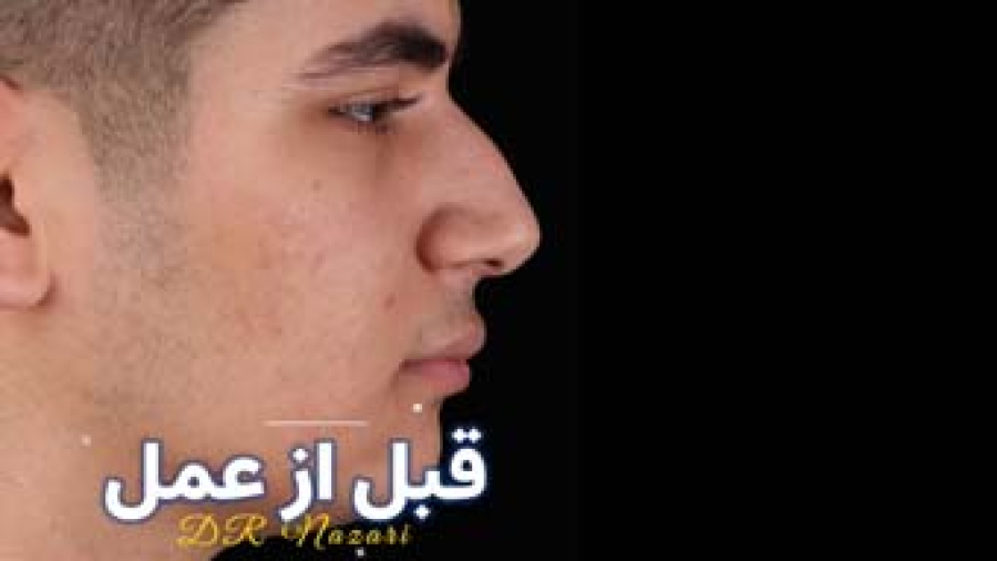 جراحی بینی مردانه | دکتر نظری