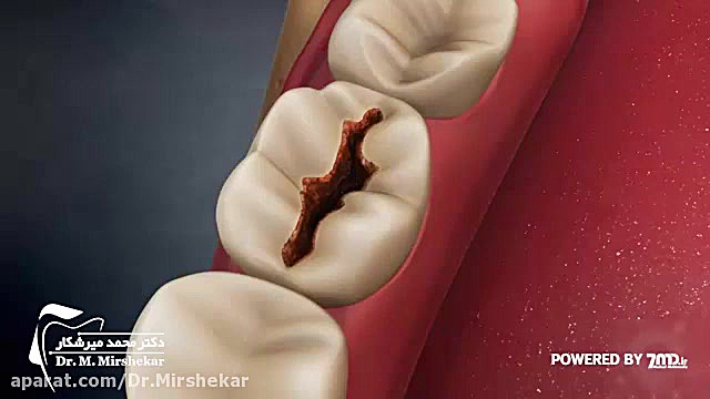 پر کردن دندان با مواد امالگام تست ایمونوبلات