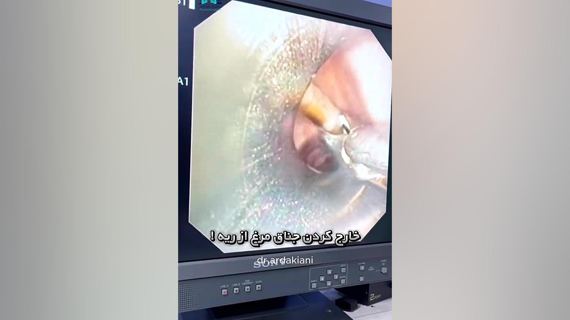 خارج کردن جناق مرغ از ریه! دکتر اردا کیانی