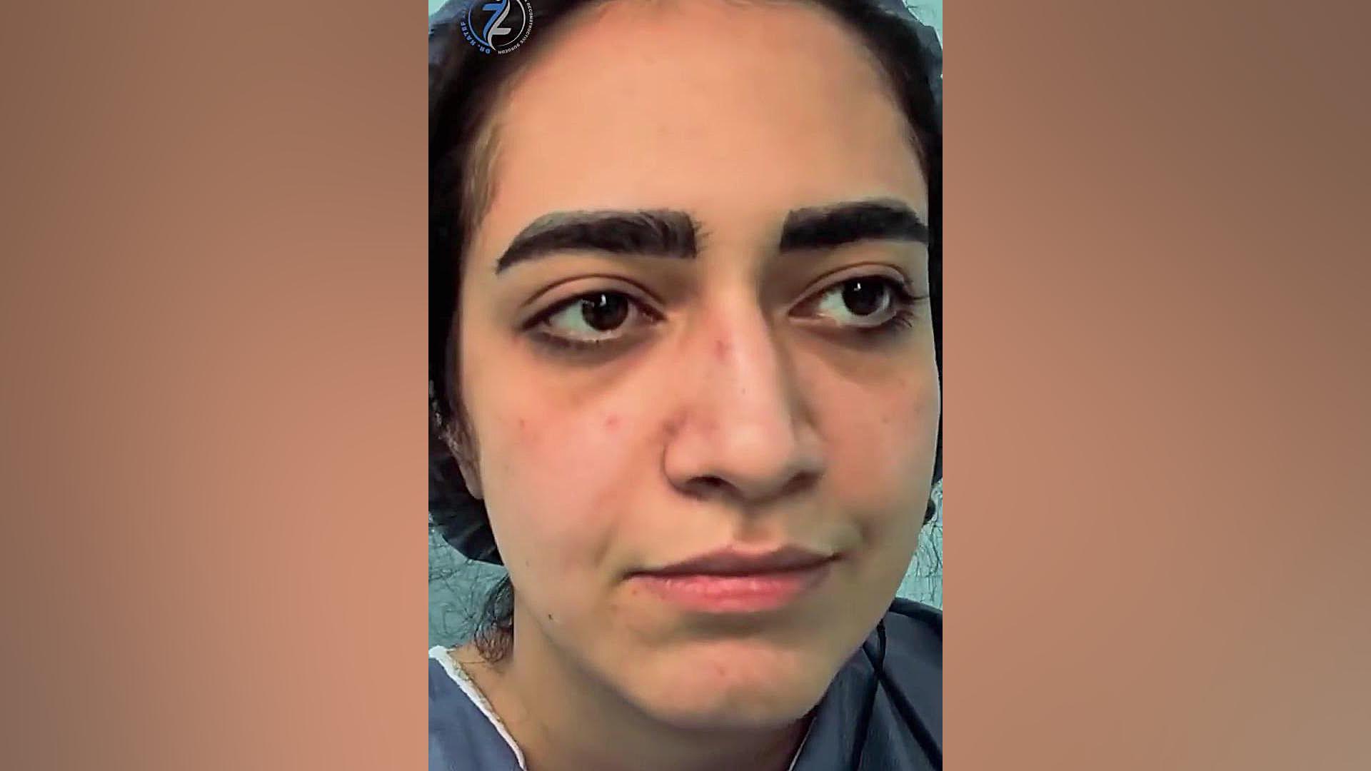 عمل بینی دارای انحراف و کجی دکتر هاتف زیرک زاده - فوق تخصص جراحی پلاستیک