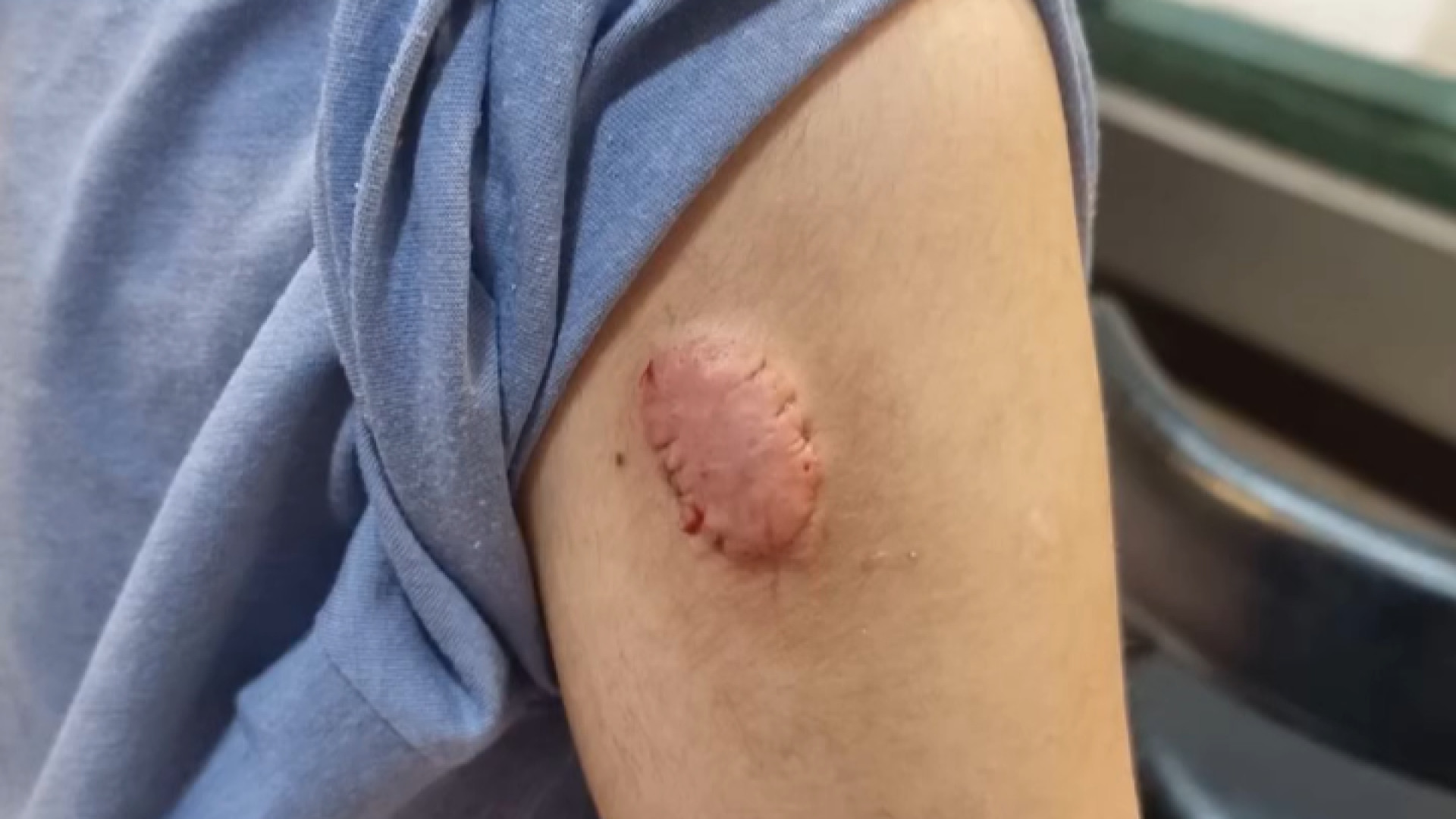 درمان کلوئید جای واکسن دکتر پروانه ساکت - متخصص پوست و مو، زیبایی