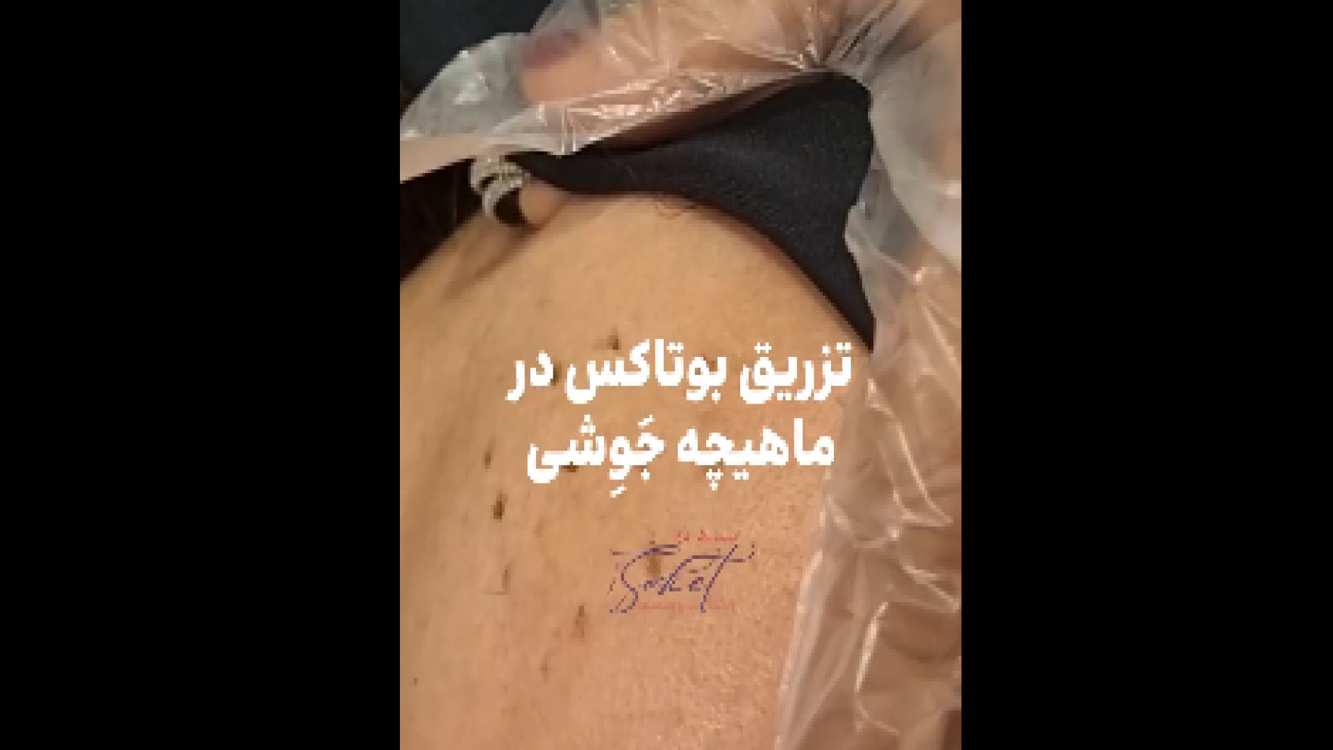 تزریق بوتاکس ماهیچه جوشی دکتر پروانه ساکت - متخصص پوست و مو، زیبایی