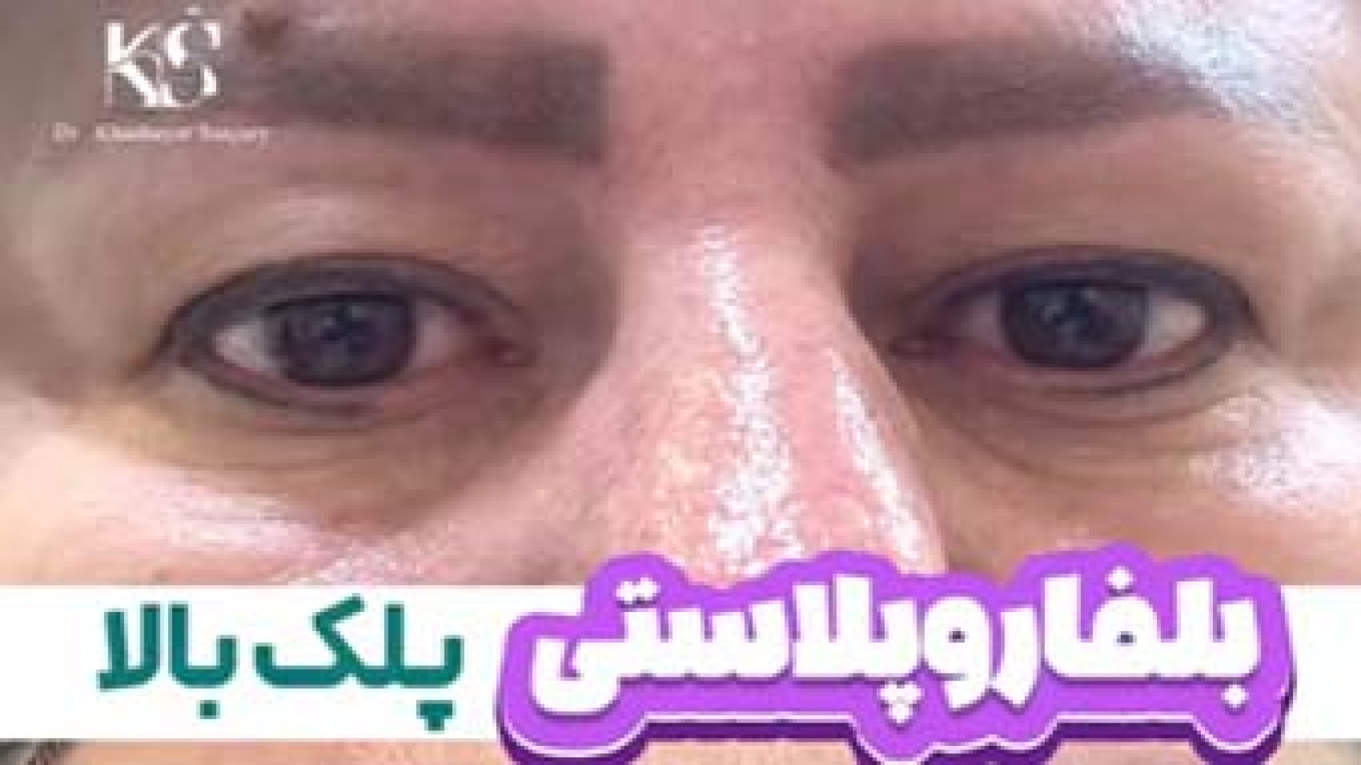 بلفاروپلاستی | دکتر خشایار سنجری دکتر خشایار سنجری متخصص جراحی جنرال و زیبایی
