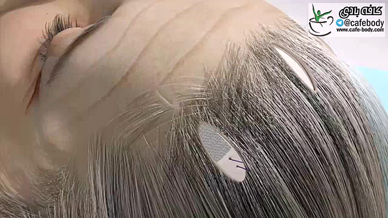 لیفت ابرو (Brow Lift) دیسمورفی فاسیال