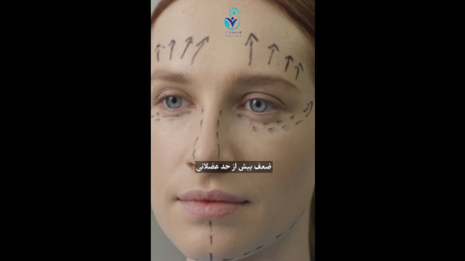 حساسیت به بــوتاکس دکتر شهرام سیدی متخصص آلرژی و ایمونولوژی