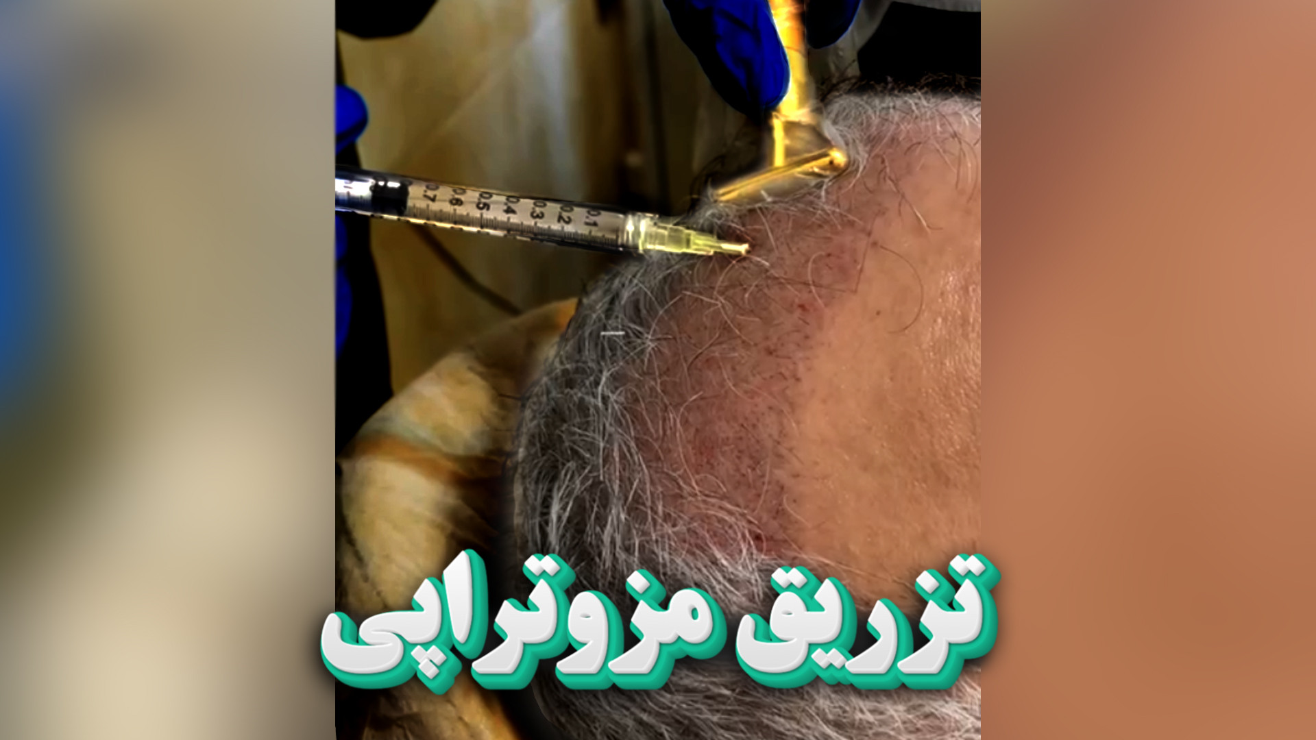 فیلم مزوتراپی مو مردان ( نحوه تزریق کوکتل مزوتراپی درمان ریزش مو ) کلینیک نوبلا سندرم تریشن-کولینز نادر