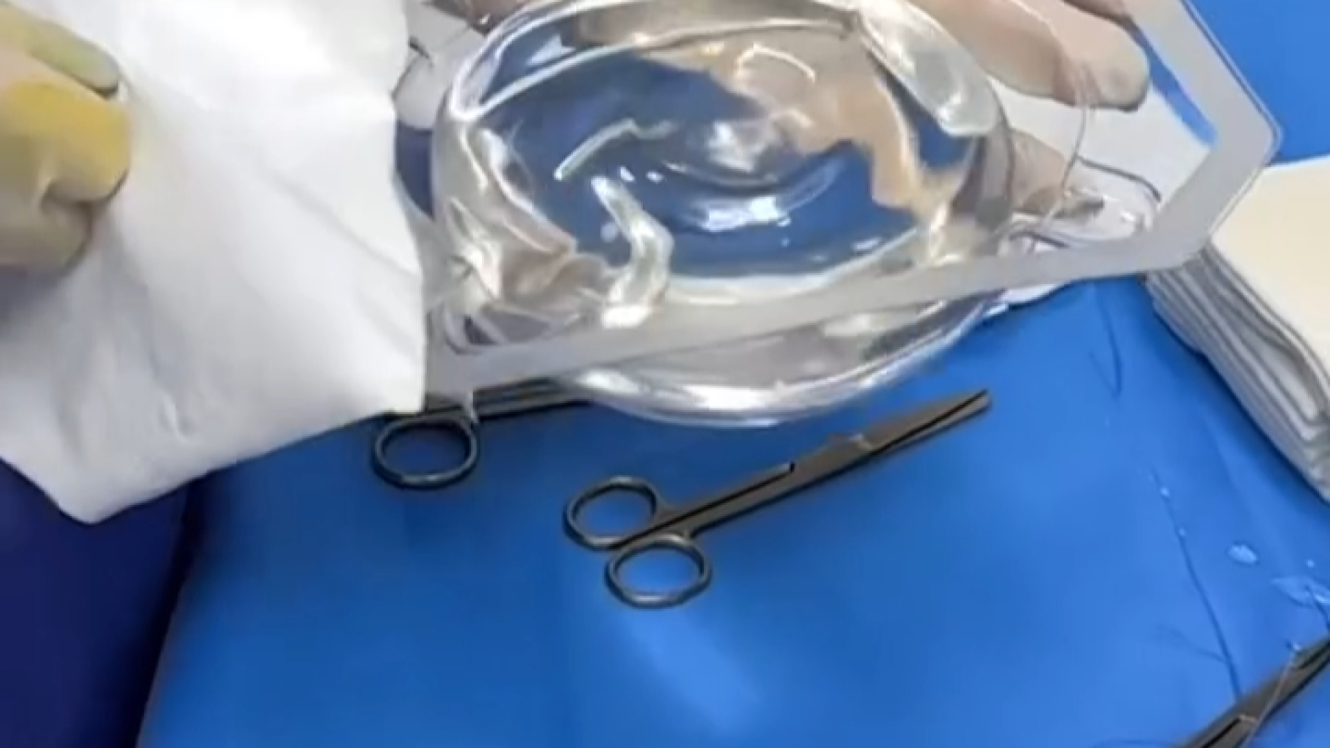 پروتز سینه | دکتر پیمان صدری پلی‌داکتیلی