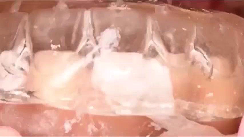 injection-technique طراحی لبخند دیجیتال همراه با اینجکشن تکنیک دکتر مریم علوی دکتر مریم علوی