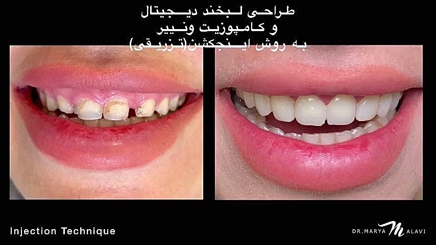 injection-technique طراحی لبخند دیجیتال همراه با اینجکشن تکنیک دکتر مریم علوی دکتر مریم علوی