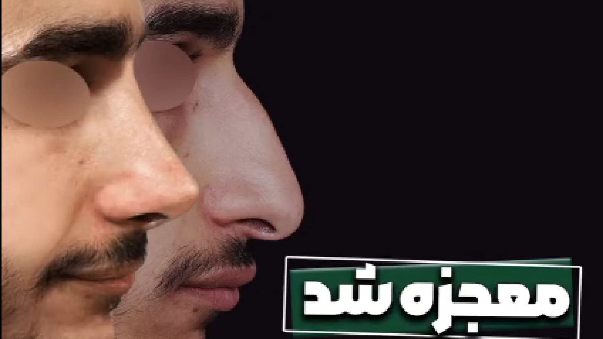 معجزه با عمل بینی | دکتر علی باقری حق دکتر علی باقری حق