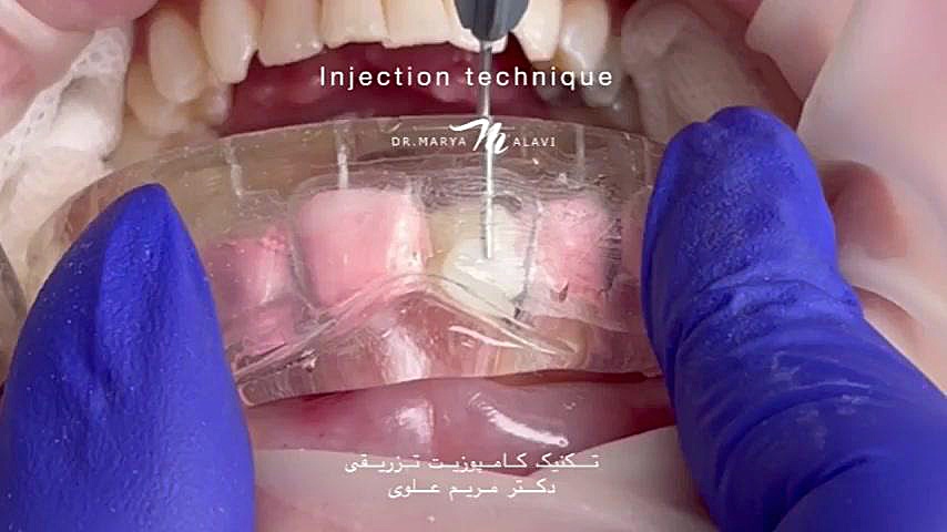 injection-technique طراحی لبخند دیجیتال همراه با اینجکشن تکنیک دکتر مریم علوی دکتر مریم علوی