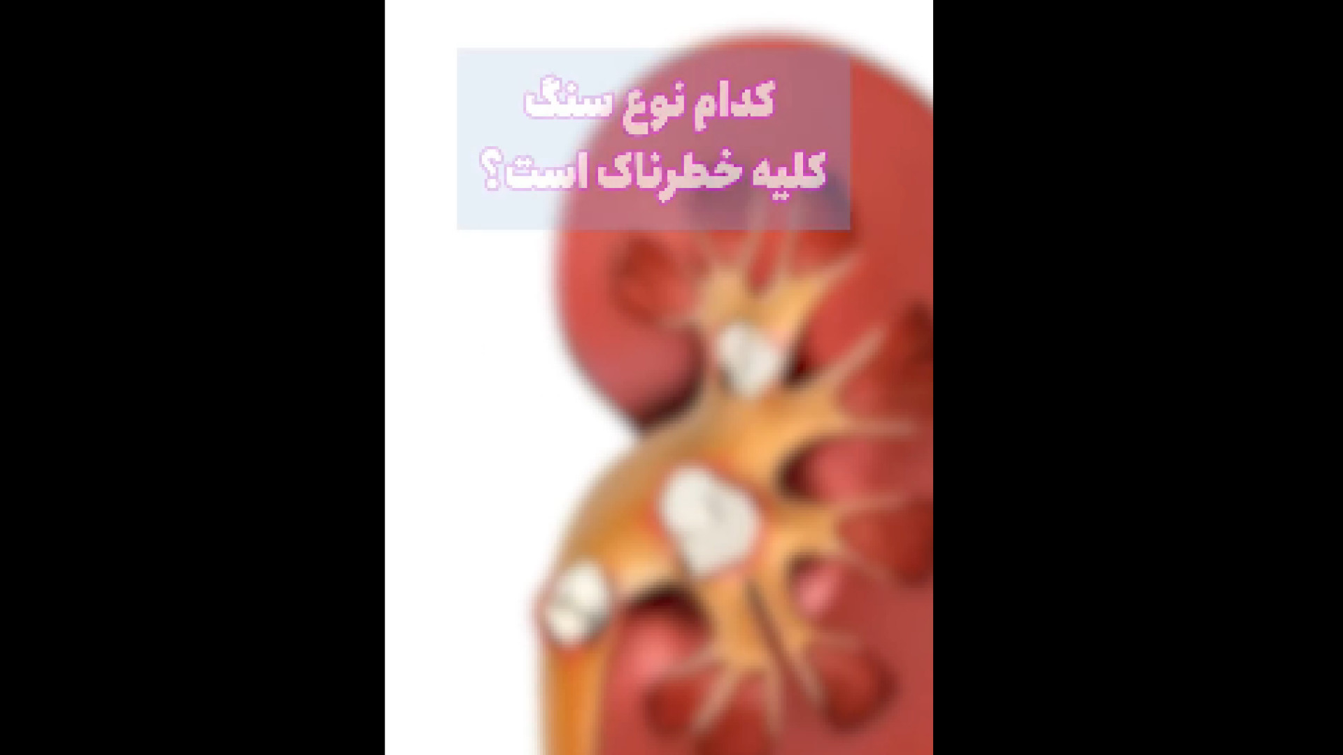 کدام نوع سنگ کلیه خطرناک است؟ درمان سلولیت