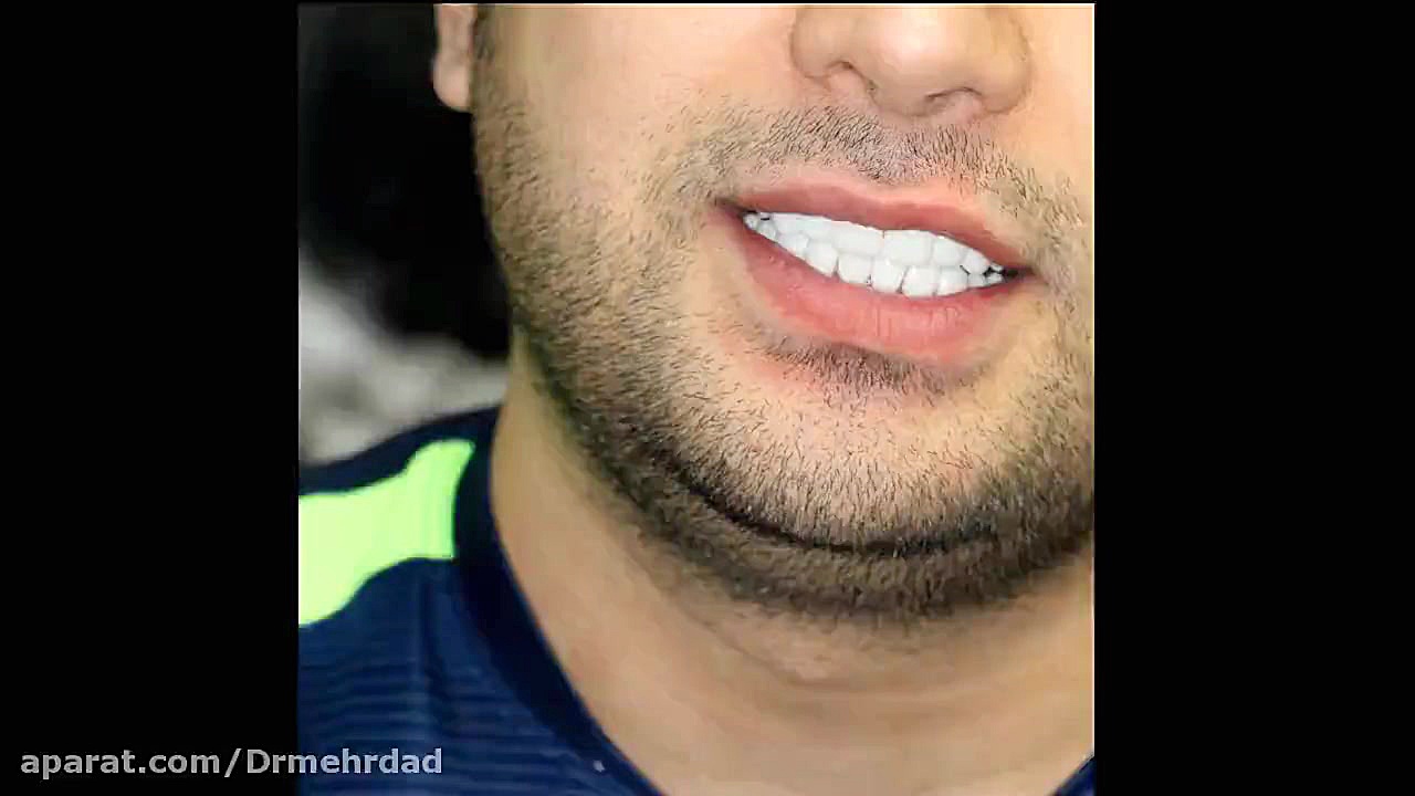 اصلاح کامل طرح لبخند توسط دکتر مهرداد بیماری پولی‌آرتریت ندوزا