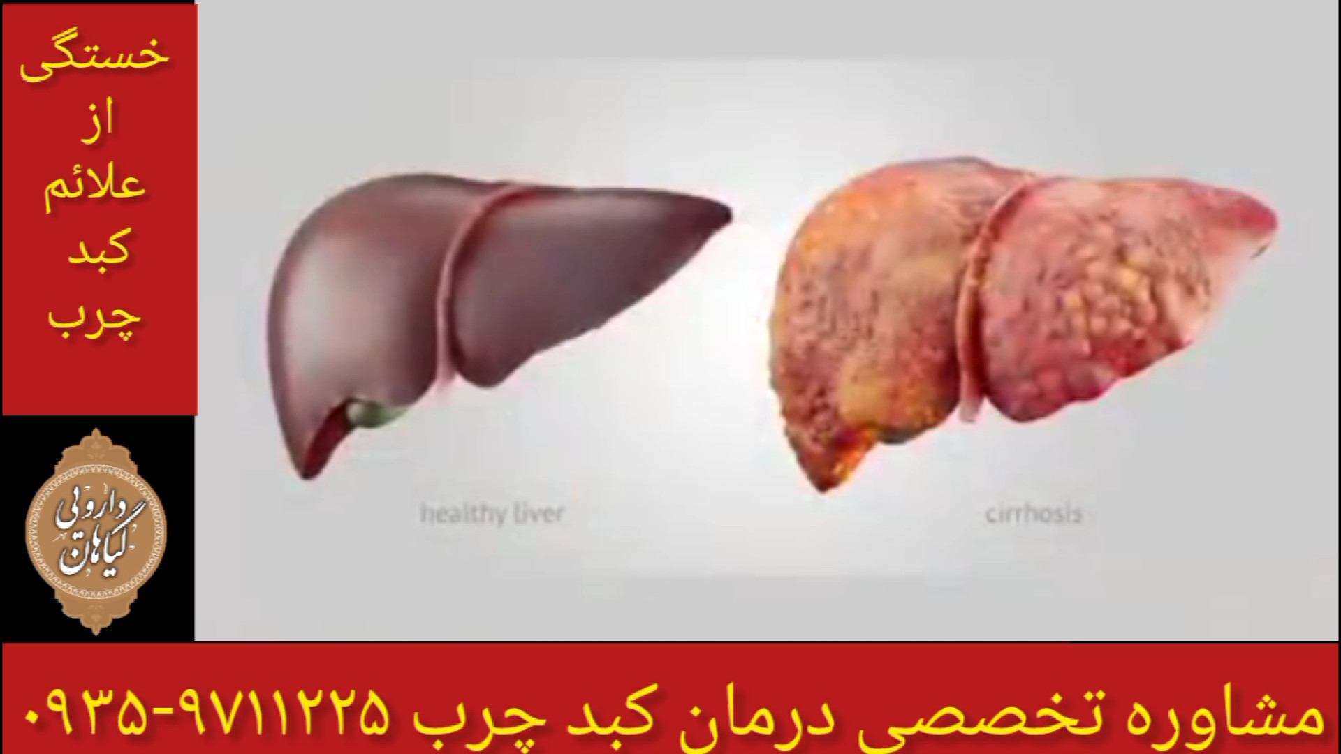 خستگی از علائم کبد چرب درمان و پاکسازی کبدچرب ۰۹۳۵۹۷۱۱۲۲۵ ساکوبیتریل