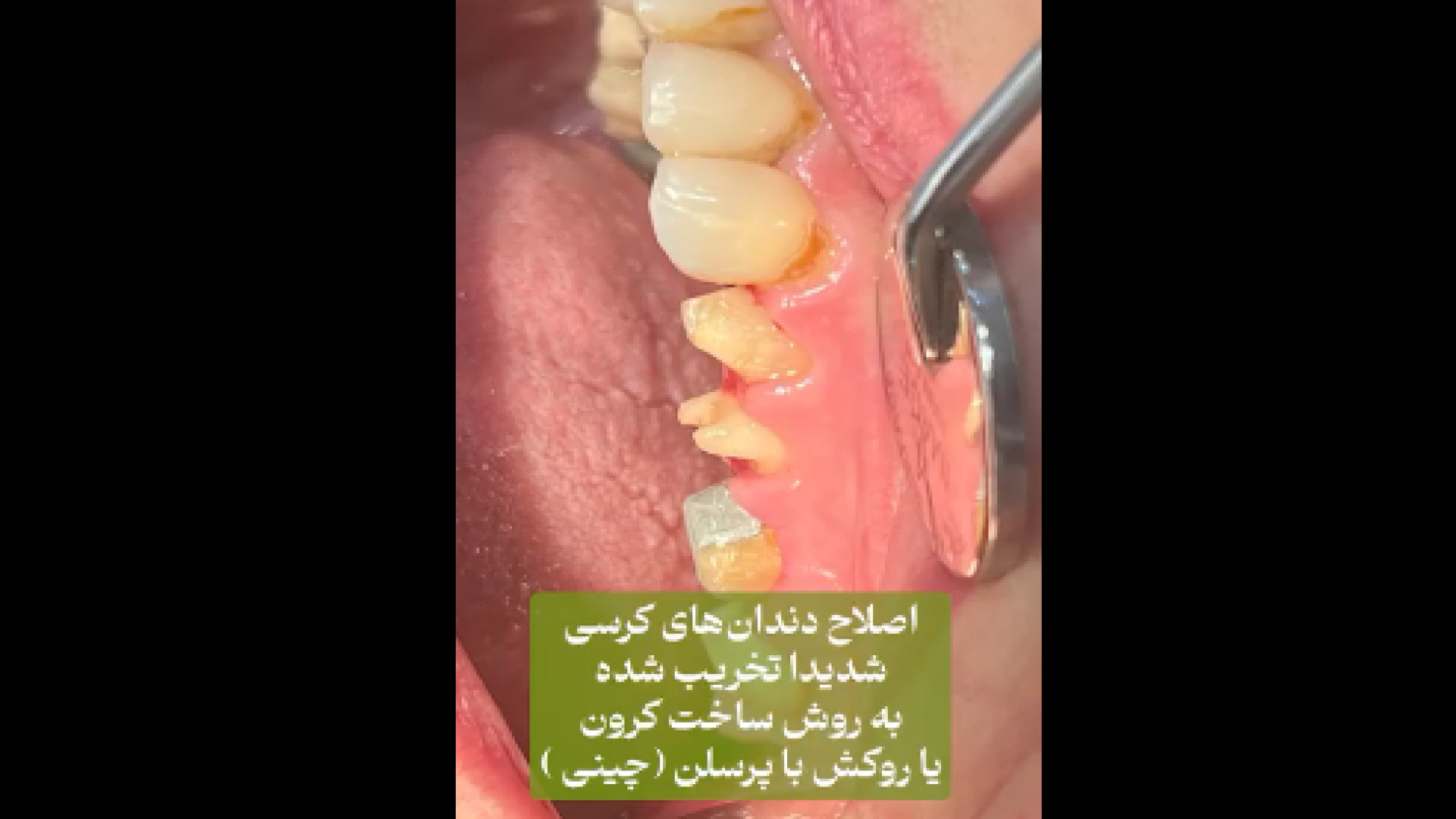 اصلاح طرح لبخند میلوشل